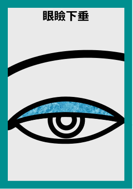 maha28510101002538 ptosis